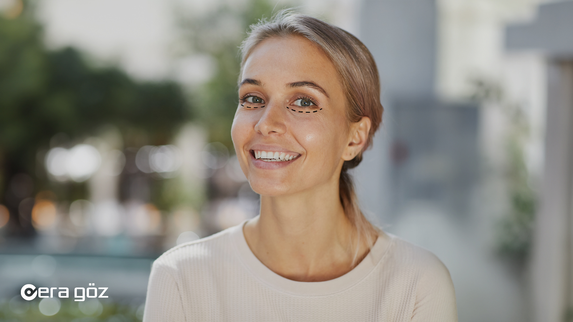 lower blepharoplasty, lower eyelid, Lower eyelid blepharoplasty, Lower eyelid bags, Lower eyelid drooping, Lower eyelid ptosis, Lower eyelid rejuvenation, era göz, era goz, era eye hospital, era goz eye hospital, eye surgery in turkey, eye surgery, lasik eye surgery antalya